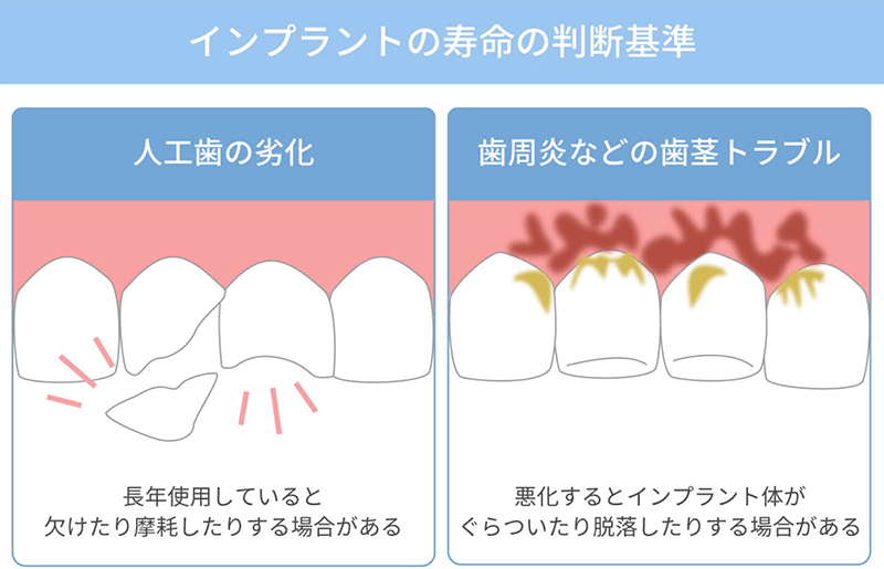 インプラントの寿命の判断基準：人工歯の劣化 / 歯肉炎などのトラブル