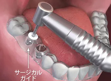 サージカルガイド